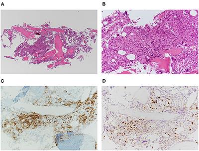 Case Report: Composite Angioimmunoblastic T-Cell Lymphoma and Epstein-Barr Virus-Positive B-Cell Lymphoproliferative Disorder as Other Iatrogenic Immunodeficiency-Associated Lymphoproliferative Disorders